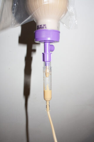 Nahaufnahme einer medizinischen Ernährungssonde, durch deren durchsichtigen Abschnitt beigefarbene Flüssignahrung fließt und die durch ein violettes Ventil vor einem schlichten Hintergrund verbunden ist.