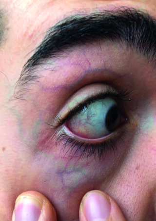 Eine Nahaufnahme des nach oben gerichteten Auges einer Person, auf der deutliche violette und grüne Adern unter der Haut um das Auge herum zu sehen sind.