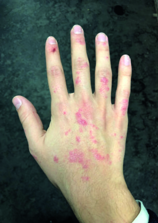 Eine Hand mit roten, schuppigen und gereizten Stellen auf der Haut, die möglicherweise Symptome einer dermatologischen Erkrankung aufweisen.