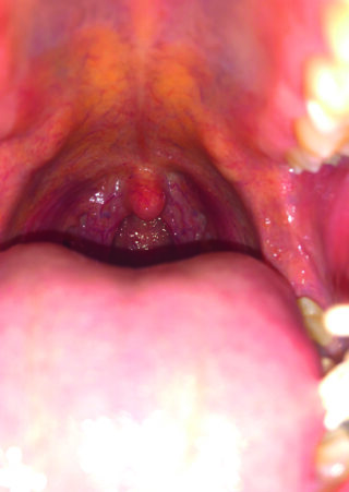 Nahaufnahme eines offenen Mundes mit sichtbarer Rötung und leichter Entzündung des Zäpfchens, der Zähne, der Zunge und des Rachens.