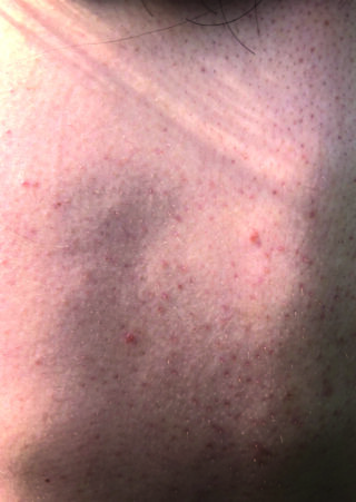 Nahaufnahme der menschlichen Haut mit sichtbaren Haarfollikeln, kleinen roten Beulen und Bereichen ungleichmäßiger Pigmentierung unter natürlichem Licht.