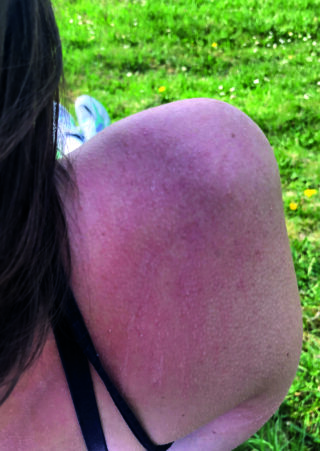 Die Schulter einer Person mit sichtbarem Sonnenbrand hebt sich von der grasbewachsenen Außenwelt ab. Auf ihrer Schulter ist der Träger eines schwarzen Oberteils zu sehen.