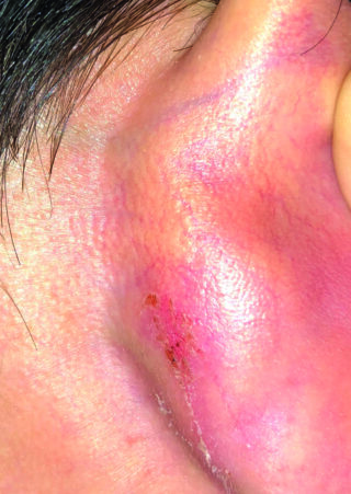 Eine Nahaufnahme der Haut einer Person, die Rötungen, Schwellungen und verkrustete Stellen in der Nähe des Ohrs zeigt, was auf eine Reizung oder mögliche Infektion hindeutet.