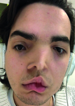 Eine Person trägt Kopfhörer mit einem verzerrten Gesichtseffekt, der ihre Gesichtszüge streckt und verzerrt.