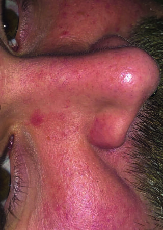 Nahaufnahme des Gesichts einer Person mit Fokus auf der Nase. Sie zeigt rote und gereizte Haut mit sichtbaren Poren und einigen Schönheitsfehlern.