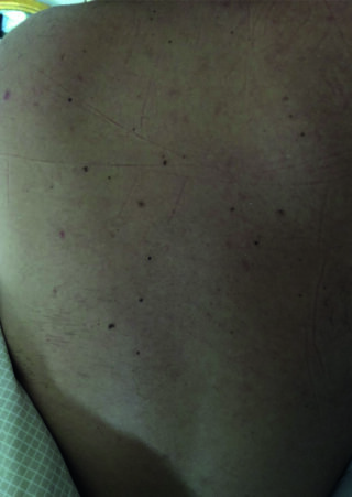 Eine Nahaufnahme des Rückens einer Person, die mehrere kleine, dunkle Flecken und einige schwache lineare Markierungen auf der Haut zeigt.