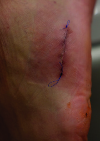 Nahaufnahme eines genähten chirurgischen Einschnitts auf der Haut mit sichtbaren blauen Nähten und leichter Rötung um die Wunde herum.