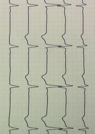 Millimeterpapier mit sich wiederholenden Wellenformspuren, die vertikale, rechteckige Muster bilden, was auf die Aufzeichnung regelmäßiger elektrischer Signale oder Impulse hindeutet.