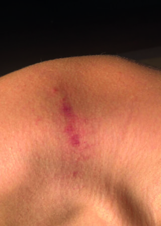 Nahaufnahme der Haut, die einen rötlich-violetten Bluterguss oder Fleck mit leichter Schwellung an einem Gelenk, möglicherweise einem Ellbogen oder Knie, zeigt.