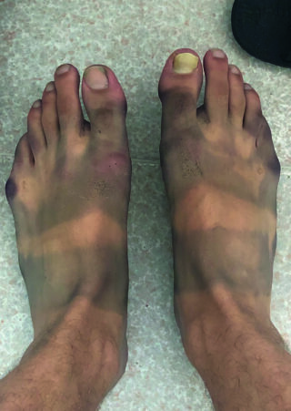 Zwei nackte Füße mit deutlichen Bräunungsstreifen, sichtbarem Schmutz, einem gelben Zehennagel am rechten Fuß und einigen Blutergüssen oder Verfärbungen an den Zehen und der Haut.