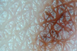 Nahaufnahme der menschlichen Haut, die eine komplexe Struktur und Muster mit einem Abschnitt brauner Pigmentierung auf der rechten Seite zeigt.