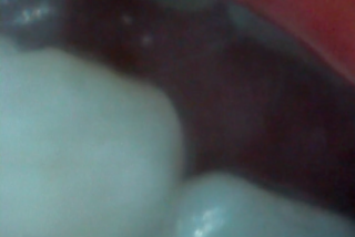 Nahaufnahme von zwei Zähnen, wobei ein Zahn eine dunkle Verfärbung in der Nähe des Zahnfleischrandes aufweist.