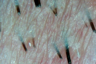 Nahaufnahme der menschlichen Haut mit sichtbaren Haarfollikeln und trockenen, schuppigen Stellen auf der Oberfläche.