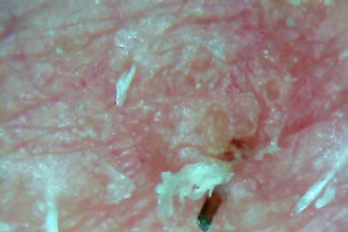 Nahaufnahme der menschlichen Haut mit trockenen, schuppigen Stellen und einem kleinen dunklen Fleck, möglicherweise einer verstopften Pore oder einem Mitesser.