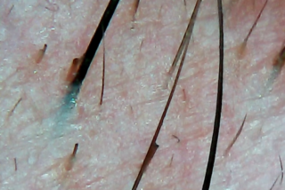 Nahaufnahme der menschlichen Haut mit sichtbaren Haarfollikeln, kurzen und langen Haarsträhnen und strukturierter Hautoberfläche.