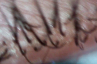 Nahaufnahme menschlicher Haut, aus der mehrere dunkle, gebogene Haarsträhnen wachsen.