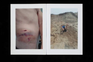 Zwei nebeneinander stehende Fotos: links ist eine gequetschte und genähte Wunde am Oberkörper einer Person zu sehen; rechts ist eine Person zu sehen, die einen sandigen Abhang hinunterstürzt.