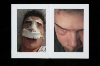 Zwei Fotos: Links ist eine liegende Person mit verbundener und blutiger Nase zu sehen; rechts ist eine Person mit geschwollener, gequetschter Haut um Augen und Nase zu sehen.
