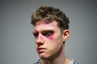 Ein junger Mann mit blauen Flecken und Schwellungen im Gesicht, insbesondere um die Augen und die Stirn, blickt vor einem schlichten Hintergrund zur Seite.