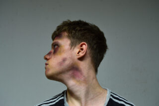 Ein junger Mann mit kurzen Haaren und sichtbaren Blutergüssen im Gesicht und am Hals blickt vor einem schlichten Hintergrund nach links.